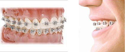 Brackets metálicos de baja fricción