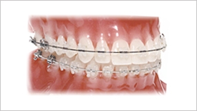 Brackets estéticos transparentes (cerámicos, de zafiro etc..)