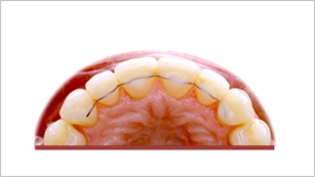 Retenedor fijo cementado  por lingual